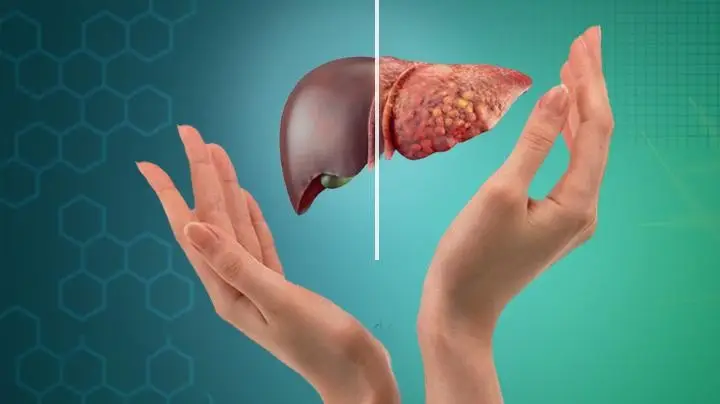UNDERSTANDING FATTY LIVER DISEASE1